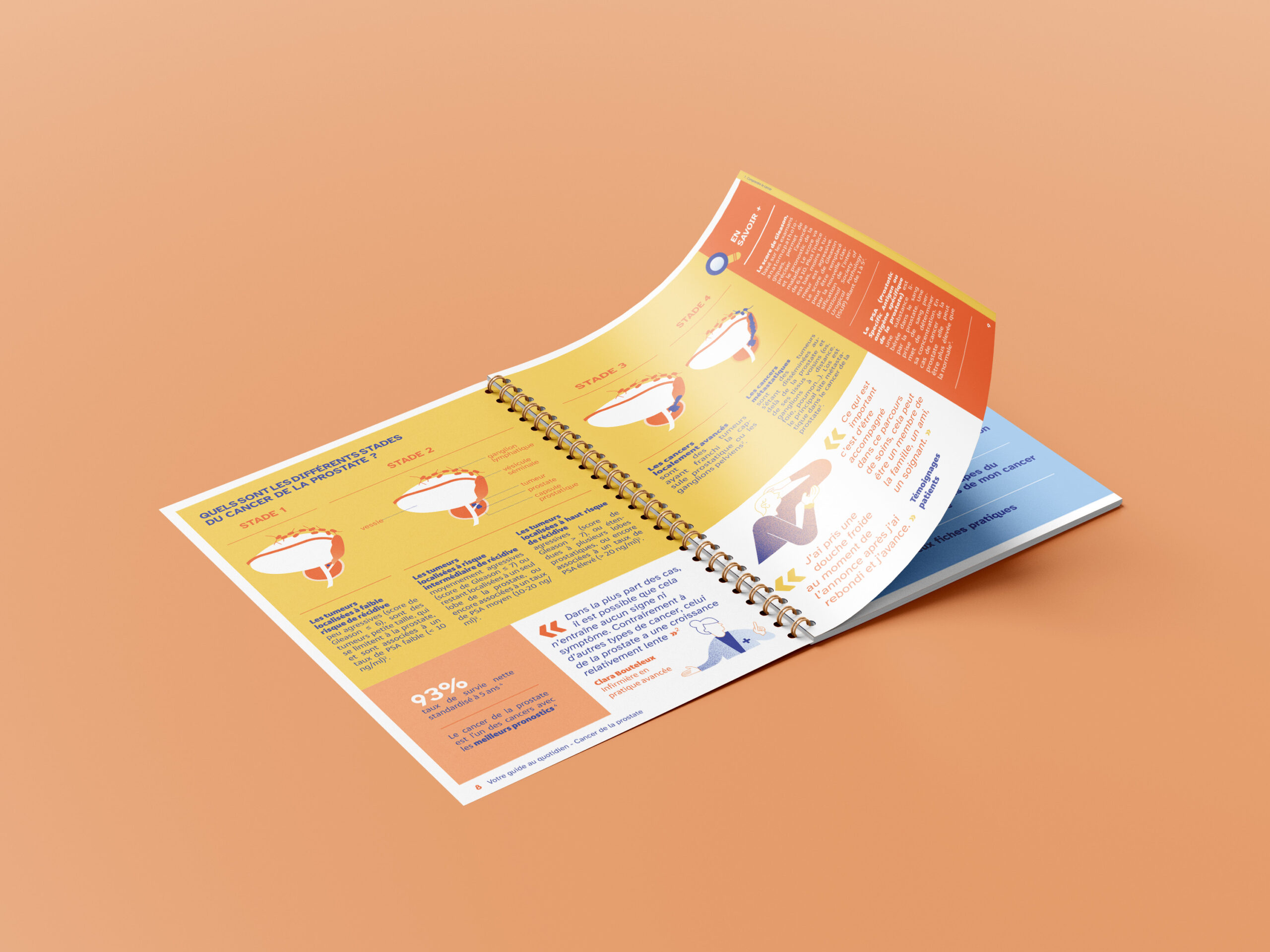 Updated patient education content for men with prostate cancer - prostate cancer stages