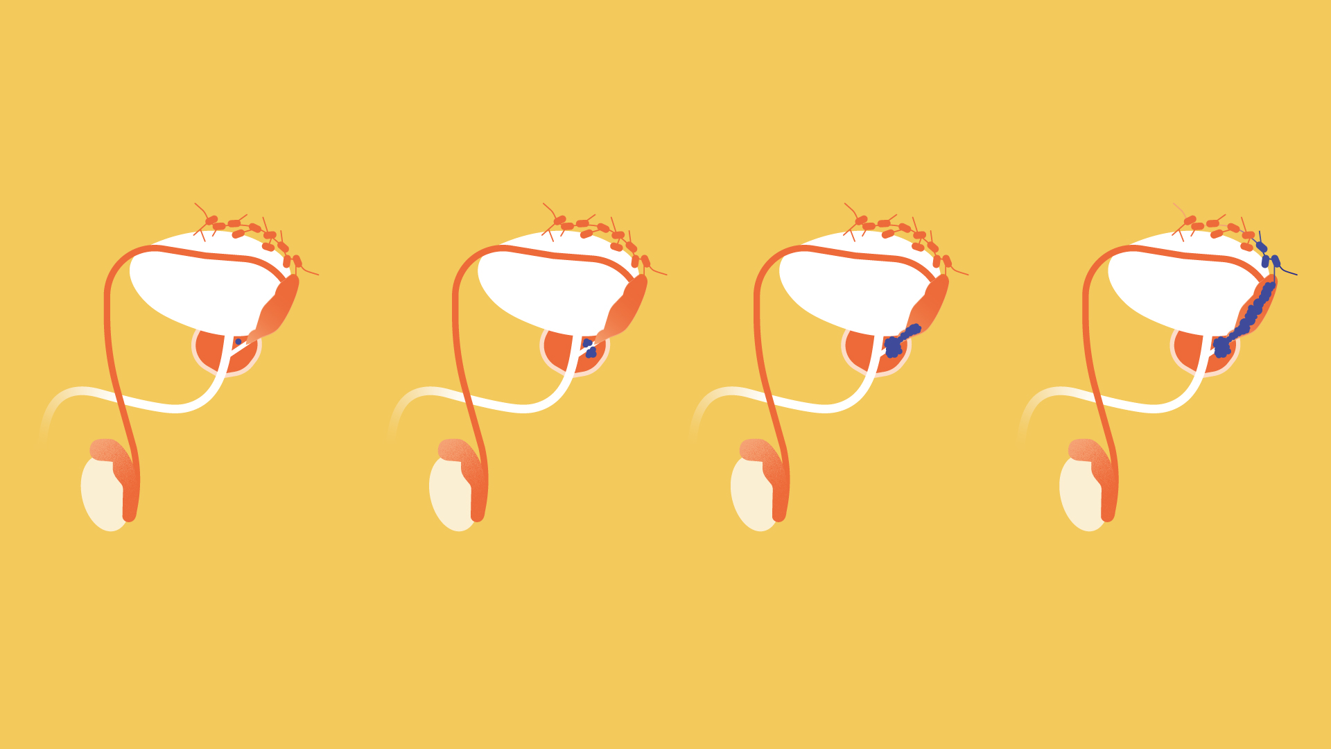 Updated patient education content for men with prostate cancer