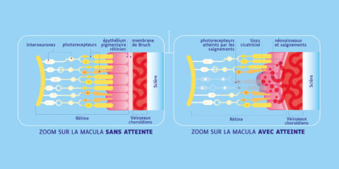 From patient information journey to experience design in AMD & DME
